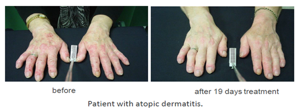 Patient with atopic dermatits